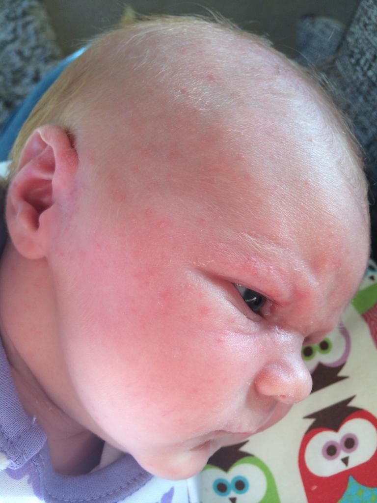 Red Spots On Babies Face Pic Babycentre